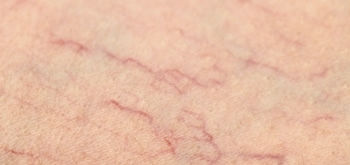 Kılcal Damar Tedavisi Ankara