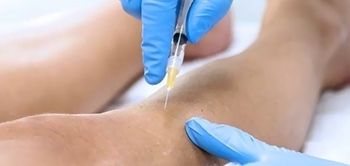 Kılcal Varis Tedavisi