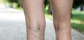 Varis Tedavisi Kırşehir